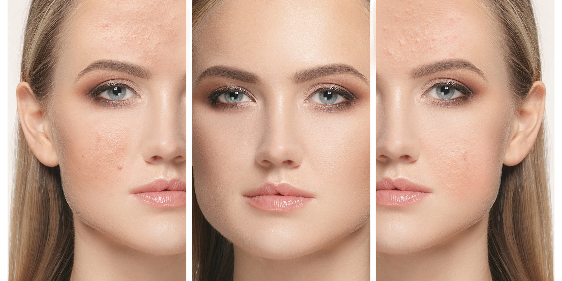 The female face of woman before and after treatment, collage
